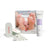 Calluspeeling 20 Treatments Refill Kit